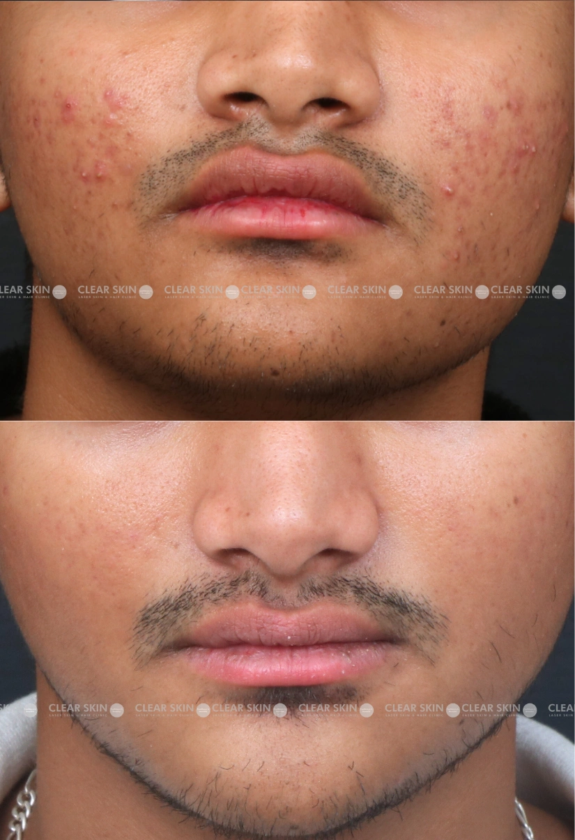 19yrs male Acne Results 6 Months Timeline 5 Sessions ClearSkin Pune (3)