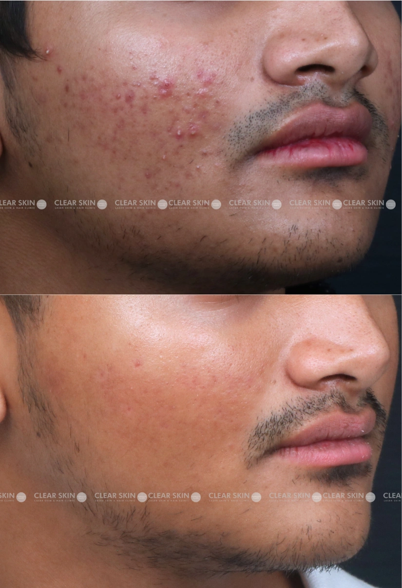 19yrs male Acne Results 6 Months Timeline 5 Sessions ClearSkin Pune