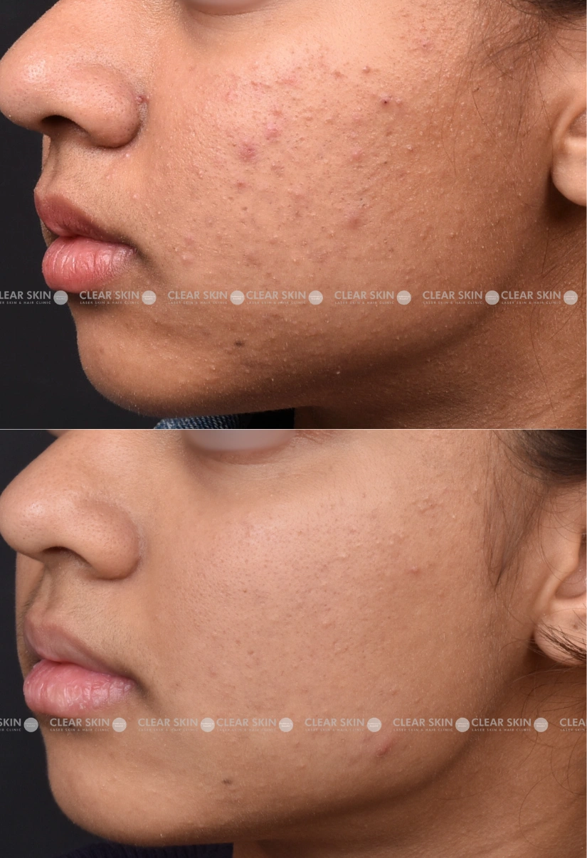 20yrs Female Acne results 3 Months Timeline 3 Sessions ClearSkin Pune (4)