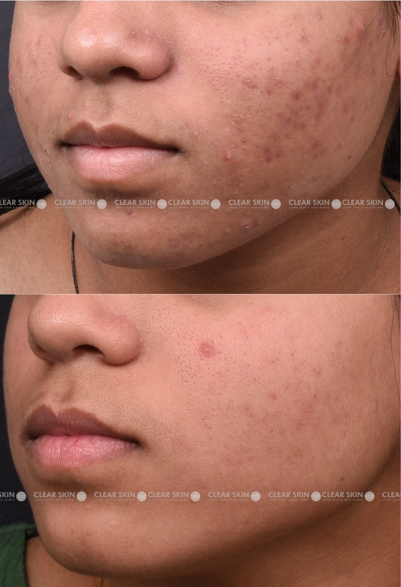 20yrs Female Acne Results 4 Months Timeline 5 Sessions ClearSkin Pune (3)