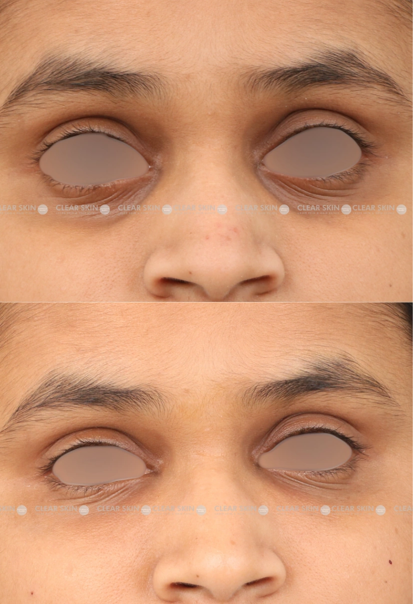 20yrs Female Darkcircle Results 3 Months Timeline 4 Sessions ClearSkin Pune