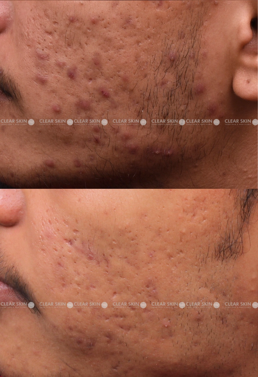 21yrs male Acne Results 6 Months Timeline 6 Sessions ClearSkin Pune (2)