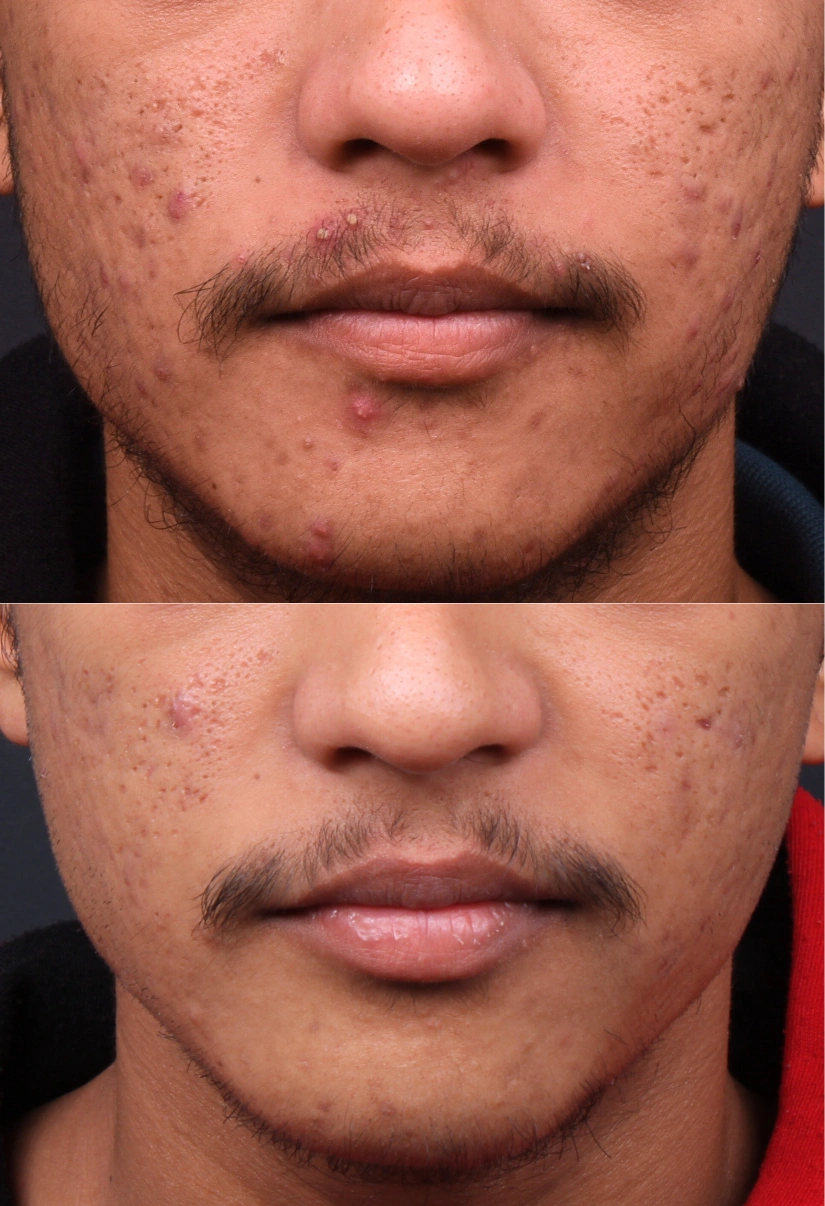 21yrs male Acne Results 6 Months Timeline 6 Sessions ClearSkin Pune (3)