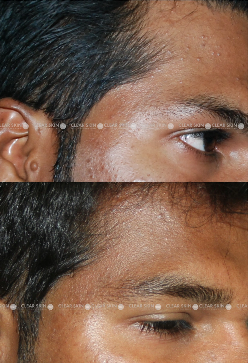 21yrs male Wart Removal Results 1 Months Timeline 1 Sessions ClearSkin Pune