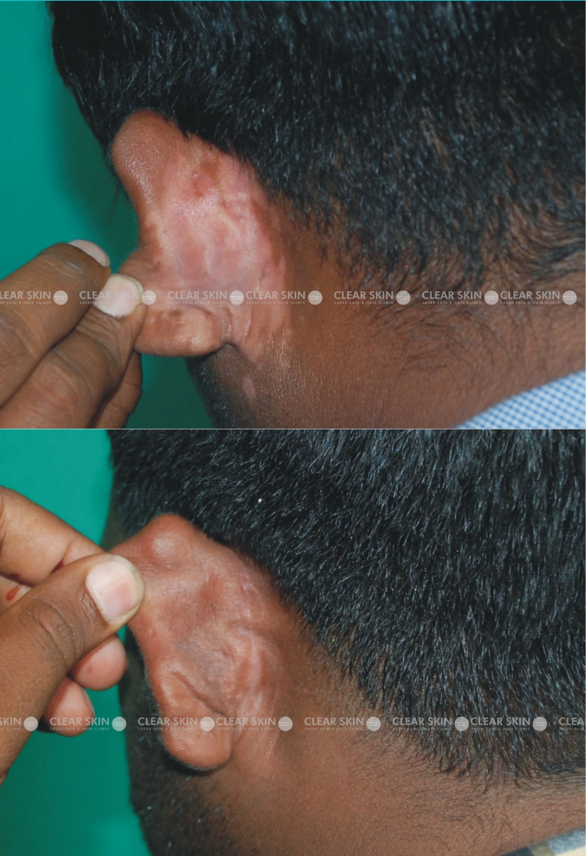 24years Male Vitiligo Results 3 Sessions 2 Months ClearSkin Pune 