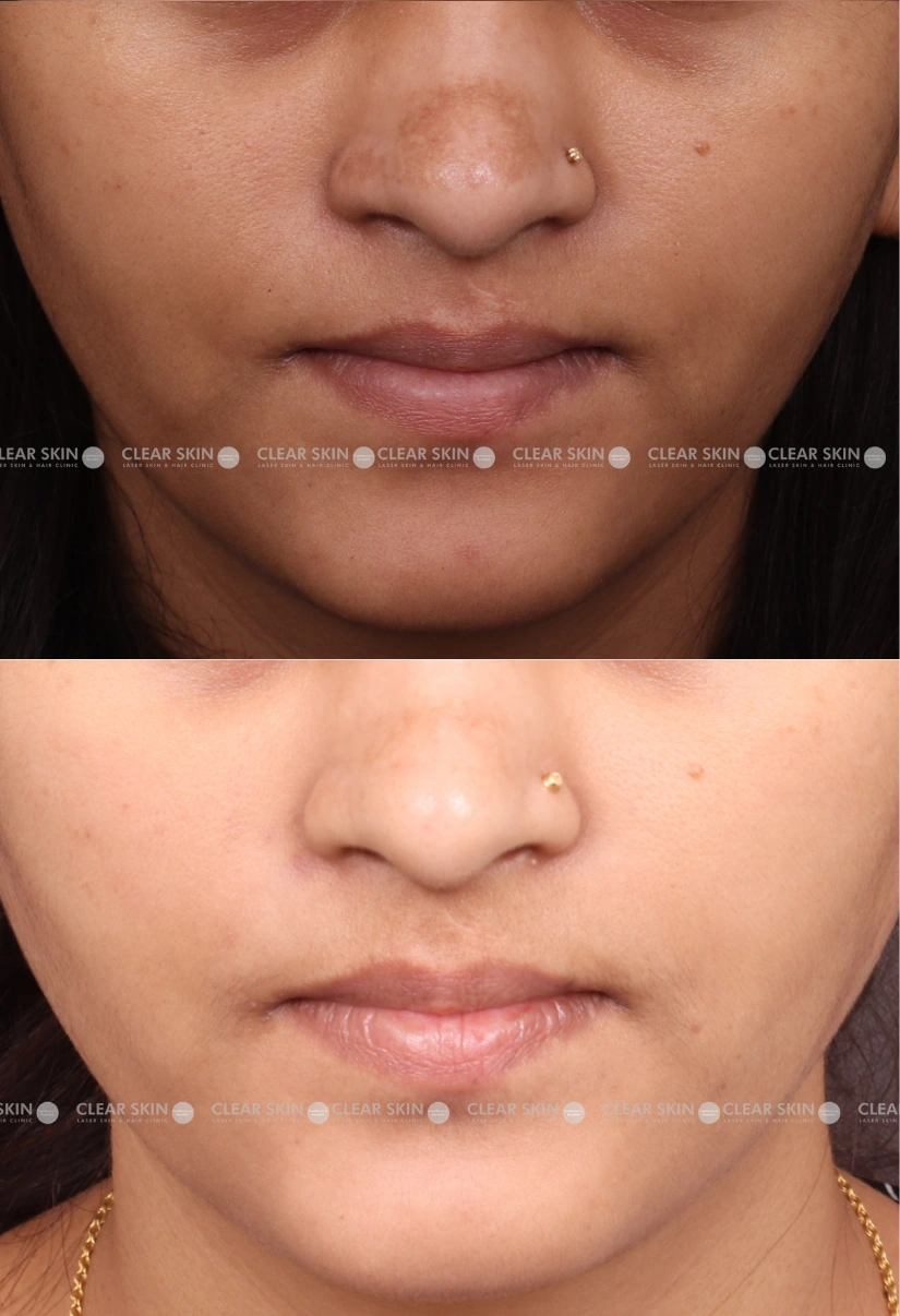 24yrs Female Melasma Results 8 Months Timeline 7 Sessions ClearSkin Pune