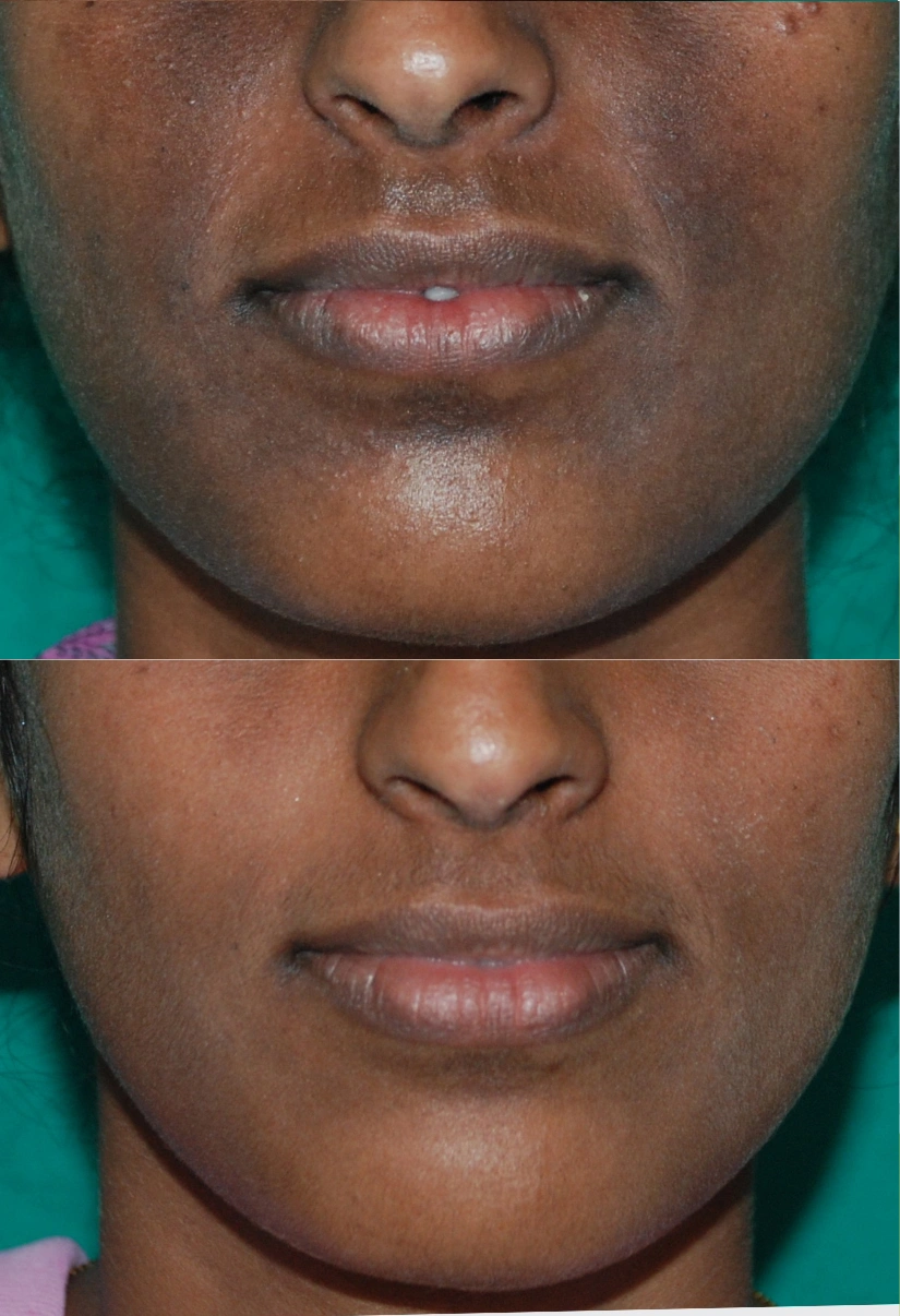 24yrs Female Pigmentation Results 2 Months Timeline 2 Sessions ClearSkin Pune (2)