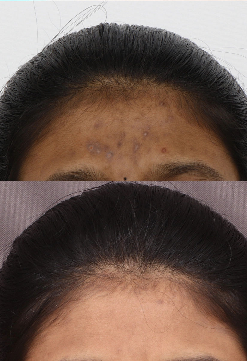 24yrs Female Pigmentation Results 4 Months Timeline 3 Sessions ClearSkin Pune