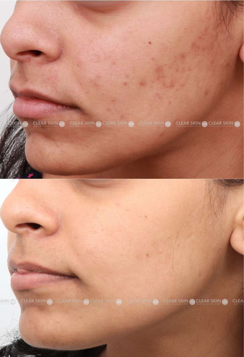 25yrs Female Acne Results 3 Months Timeline 3 Sessions ClearSkin Pune (2)