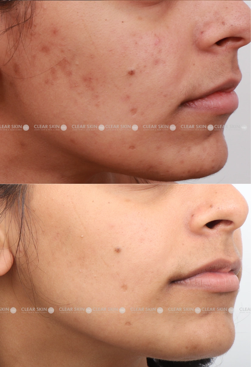 25yrs Female Acne Results 3 Months Timeline 3 Sessions ClearSkin Pune (3)