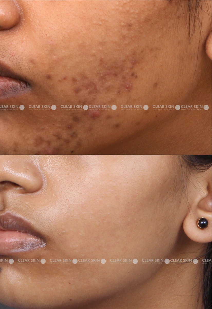 25yrs Female Acne Results 6 Months Timeline 5 Sessions ClearSkin Pune (2)