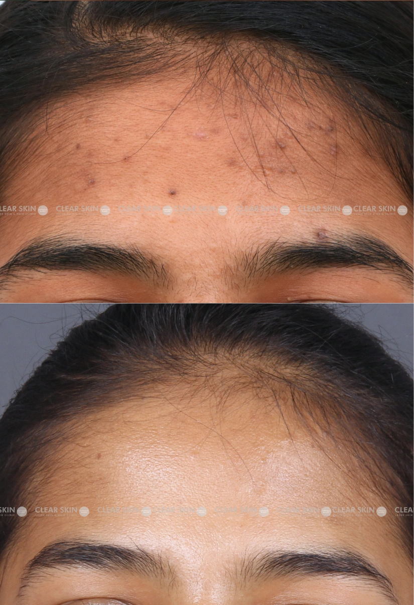 25yrs Female Acne Results 6 Months Timeline 5 Sessions ClearSkin Pune