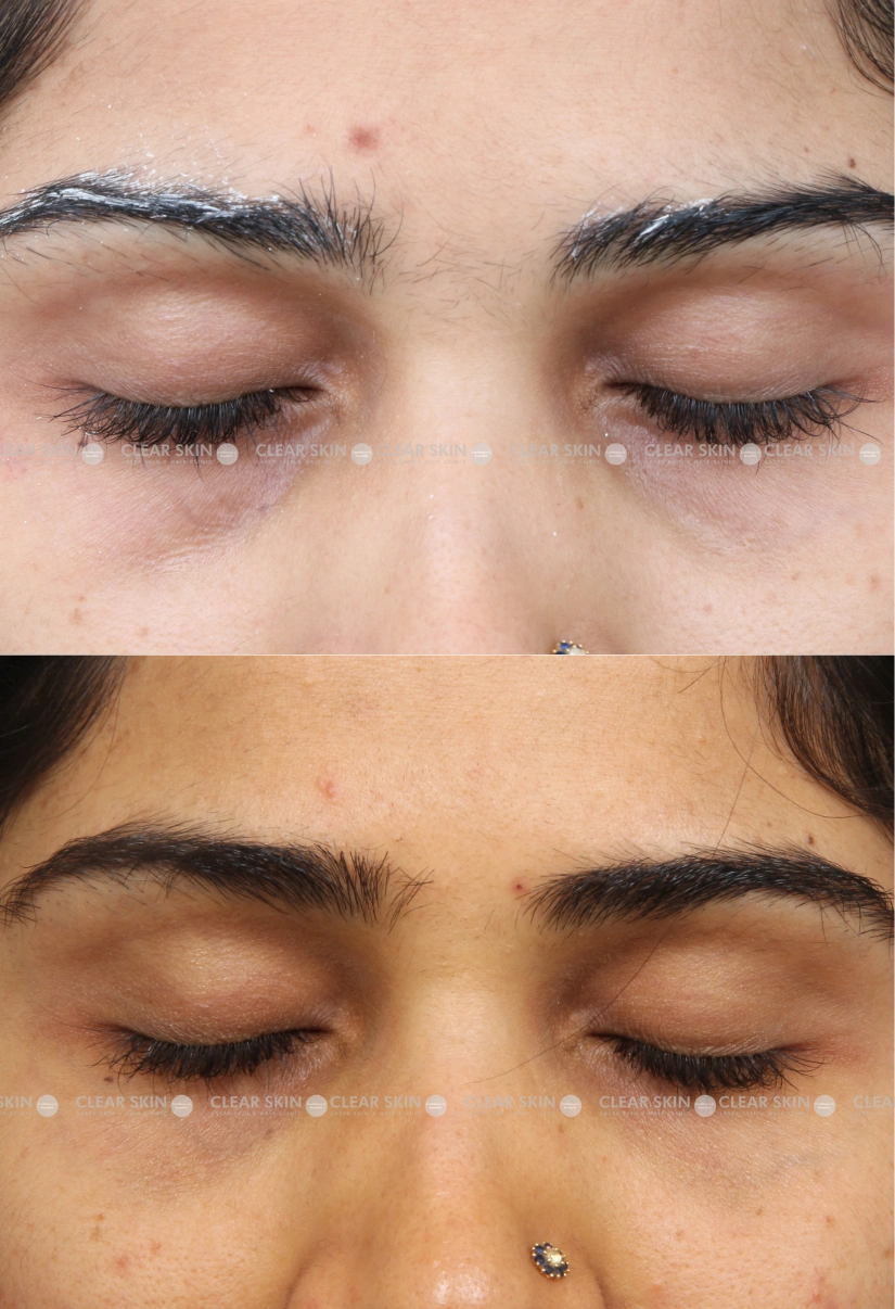 25yrs Female Darkcircles Results 5 Months Timeline 4 Sessions ClearSkin Pune