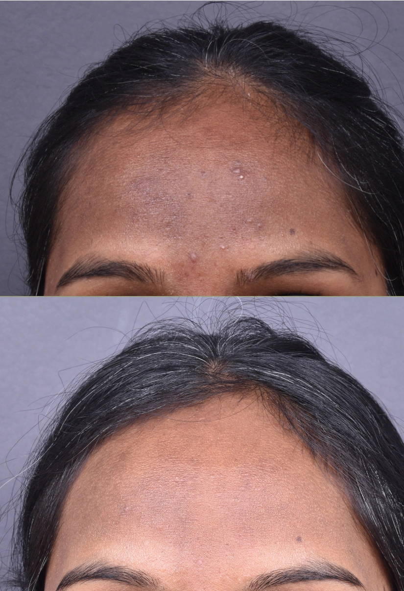 25yrs Pigmentation Results 6 Months Timeline 6 Sessions ClearSkin Pune