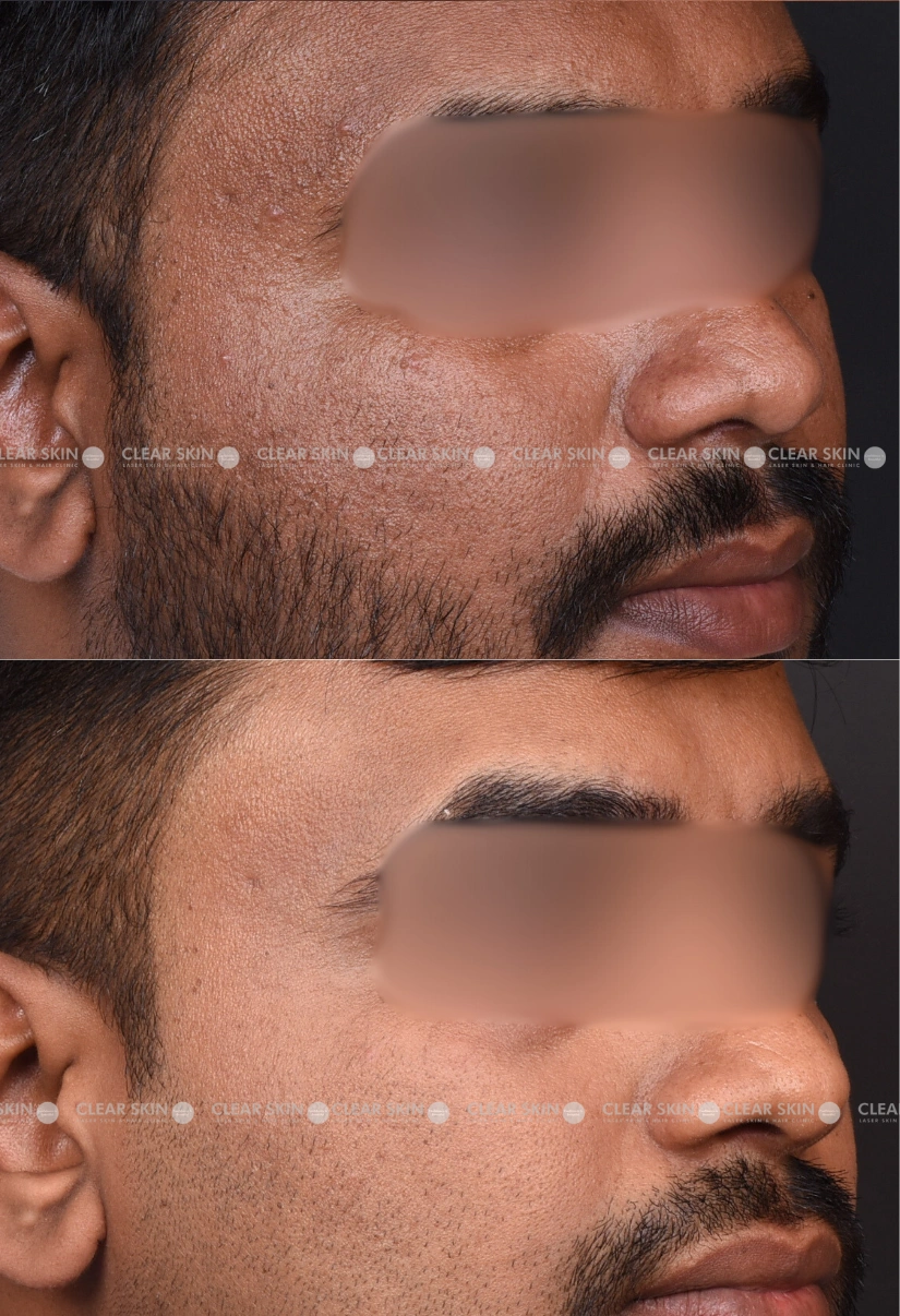 25yrs male Pigmentation Results 6 Months Timeline 5 Sessions ClearSkin Pune