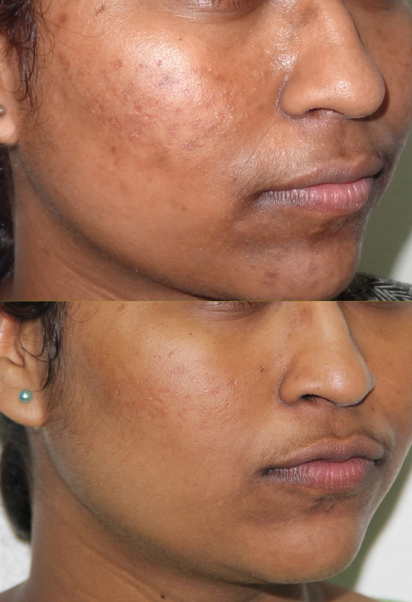 26yrs Pigmentation Results 4 Months Timeline 4 Sessions ClearSkin Pune