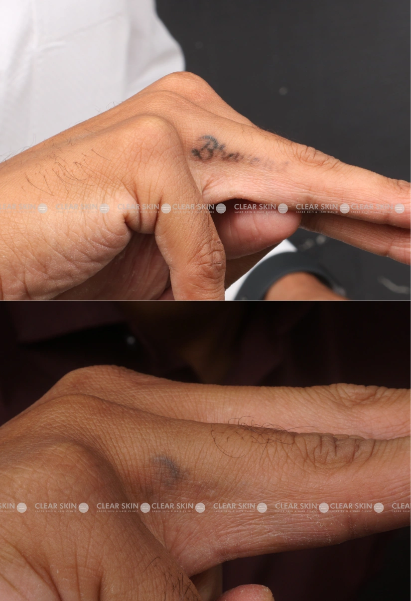 26yrs male Tattoo Removal Results 4 Months Timeline 3 Sessions ClearSkin Pune