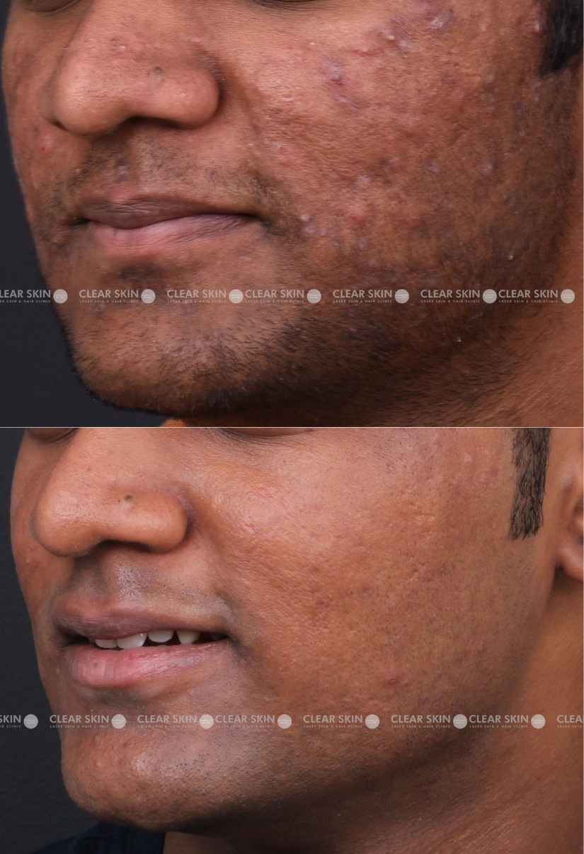 26yrs male Acne Results 9 Months Timeline 10 Sessions ClearSkin Pune (2)