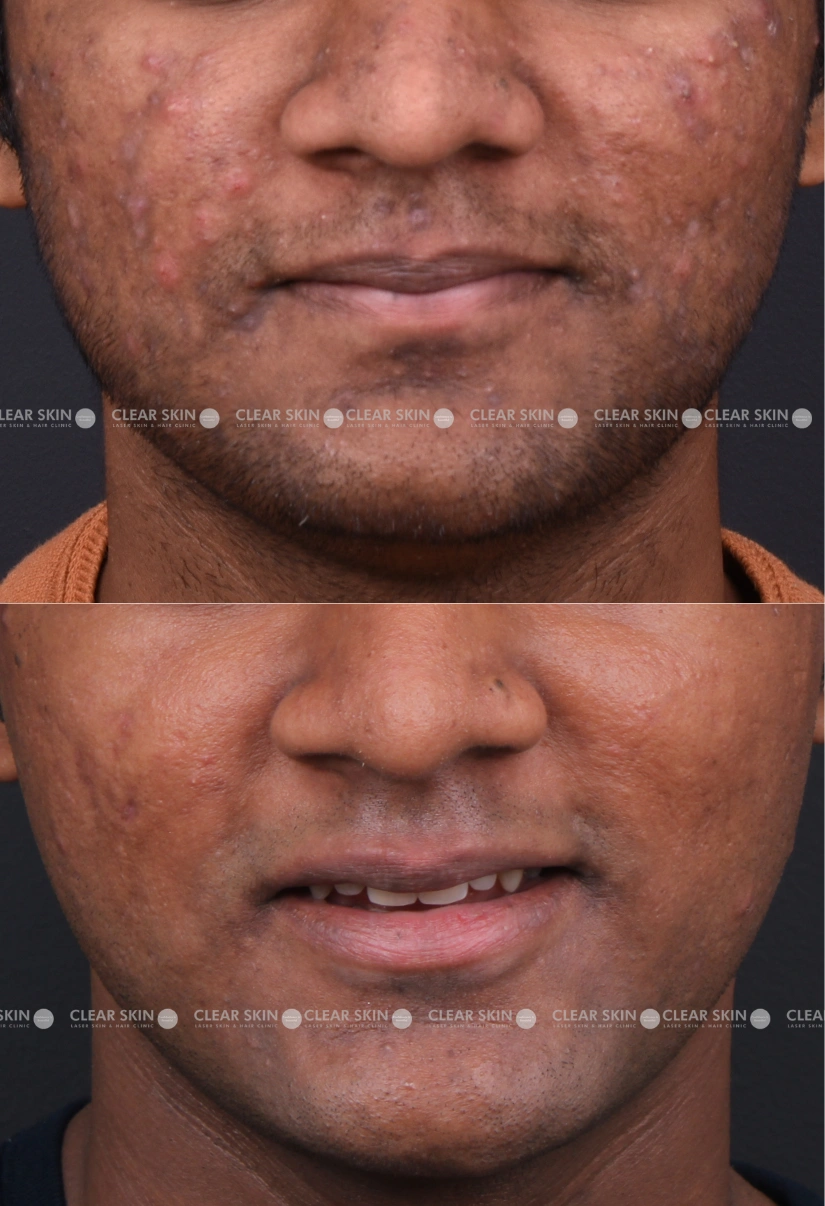 26yrs male Acne Results 9 Months Timeline 10 Sessions ClearSkin Pune