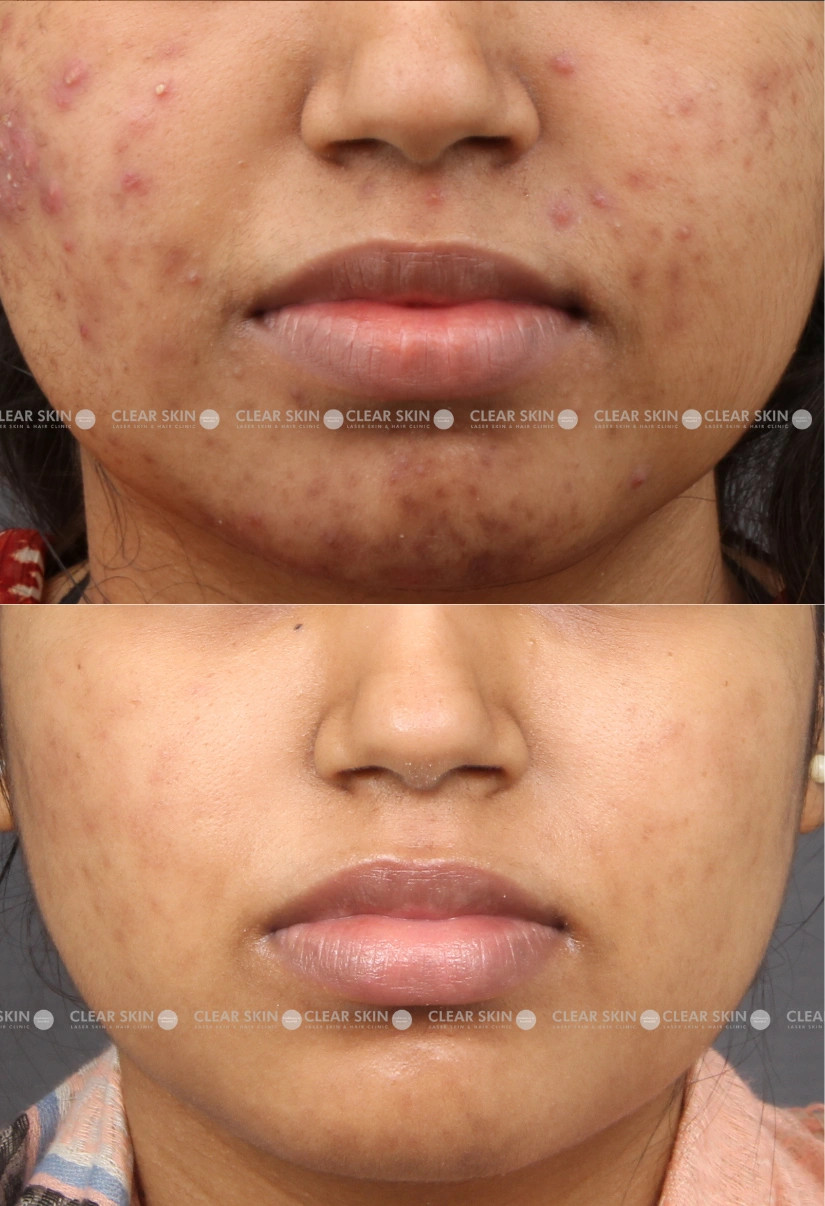 27yrs Female Acne Results 10 Months Timeline 10 Sessions ClearSkin Pune (2)