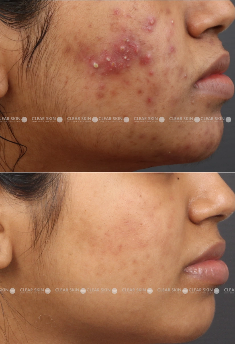 27yrs Female Acne Results 10 Months Timeline 10 Sessions ClearSkin Pune