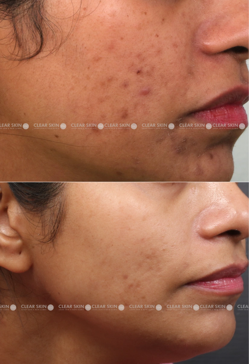 27yrs Female Freckles Results 5 Months Timeline 3 Sessions ClearSkin Pune