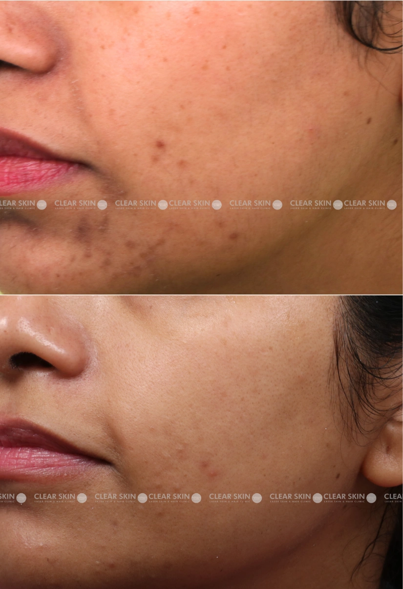 27yrs Female Freckles Results 5 Months Timeline 3 Sessions ClearSkin Pune