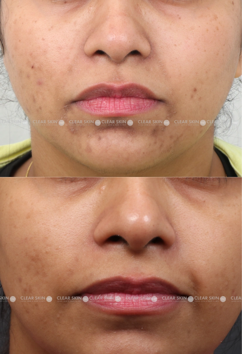 27yrs Female Freckles Results 5 Months Timeline 3 Sessions ClearSkin Pune