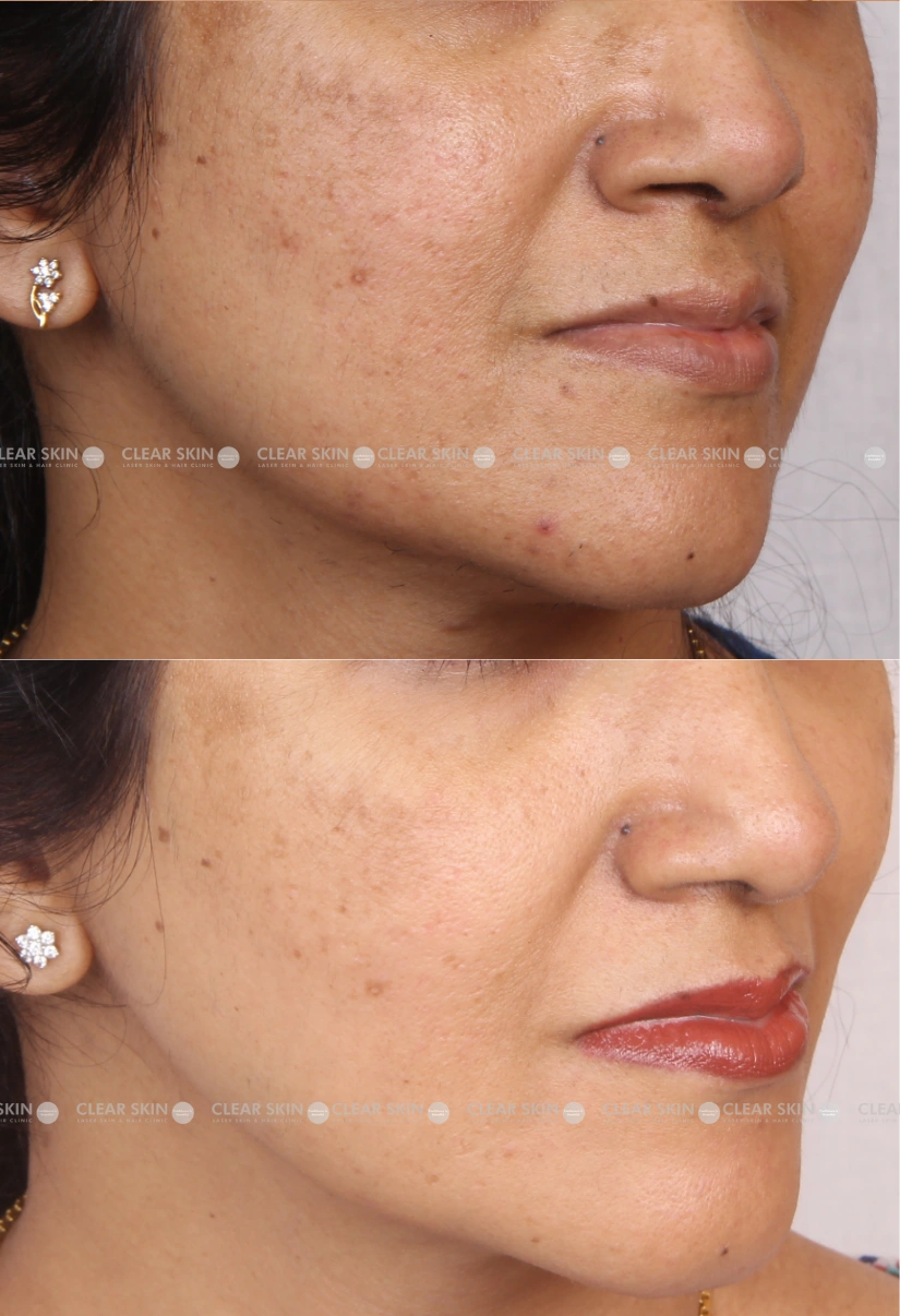 27yrs Female Melasma Results 3 Months Timeline 4 Sessions ClearSkin Pune (2)