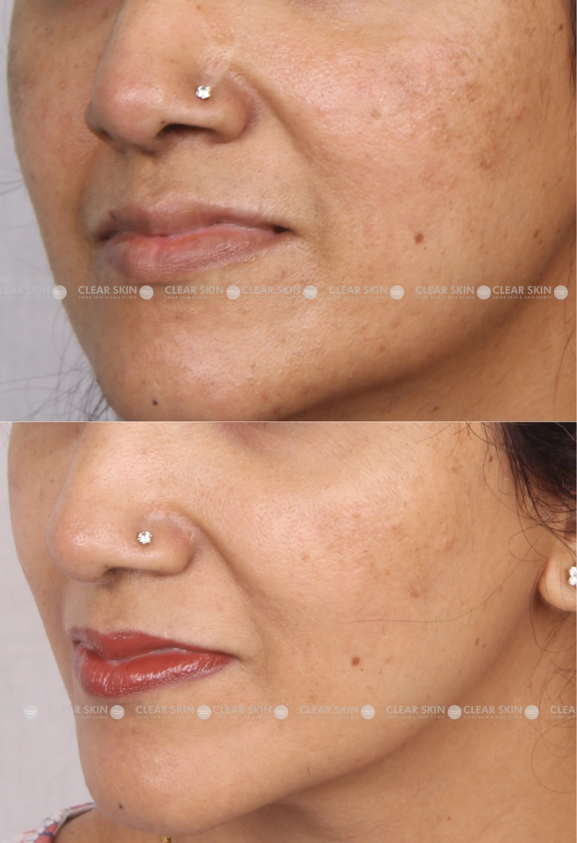 27yrs Female Melasma Results 3 Months Timeline 4 Sessions ClearSkin Pune (3)