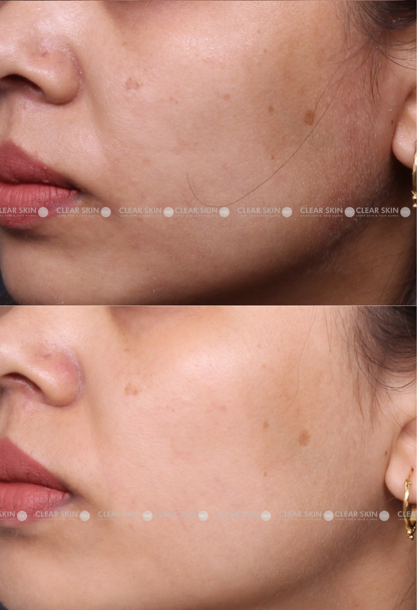 27yrs Female Melasma Results 5 Months Timeline 6 Sessions ClearSkin Pune (3)