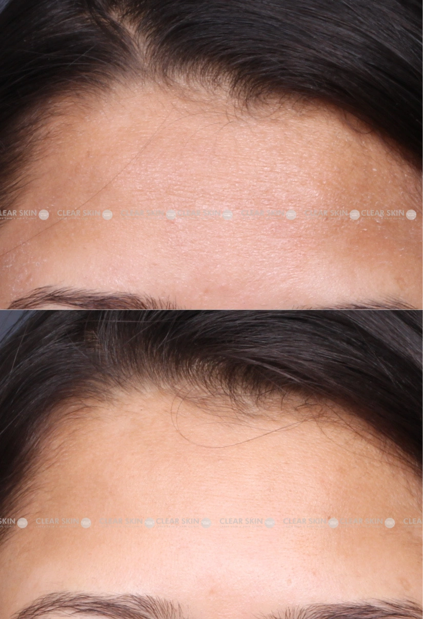 27yrs Female Melasma Results 5 Months Timeline 6 Sessions ClearSkin Pune