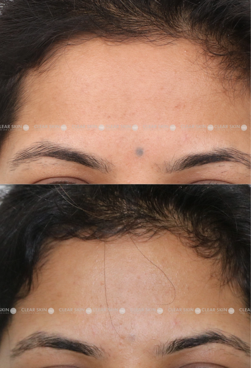 27yrs Female Tattoo Removal Results 1 Months Timeline 2 Sessions ClearSkin Pune