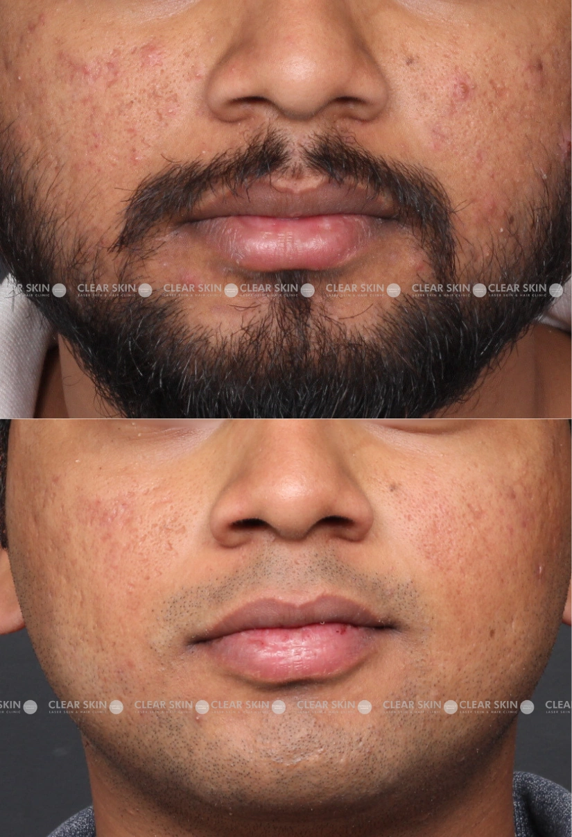 27yrs male Acne Results 6 Months Timeline 7 Sessions ClearSkin Pune 2