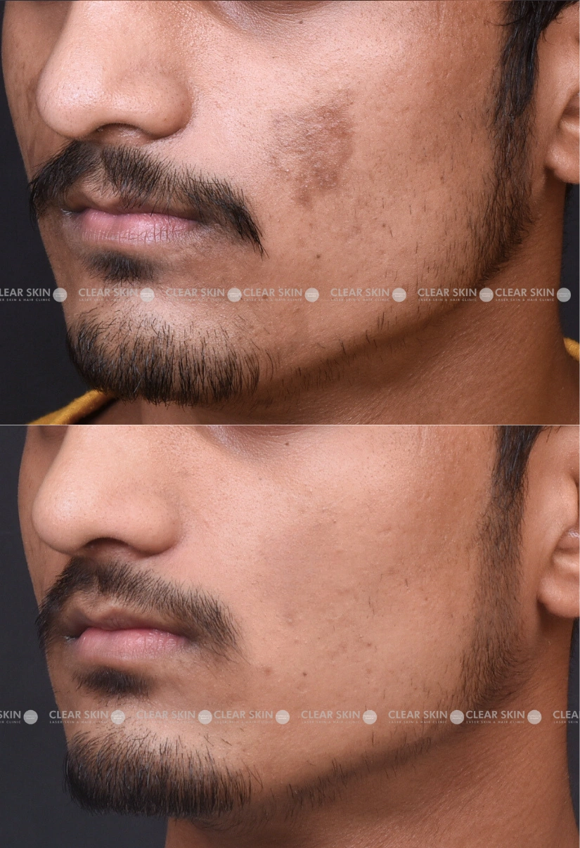 27yrs male Pigmentation Results 4 Months Timeline 5 Sessions ClearSkin Pune (2)