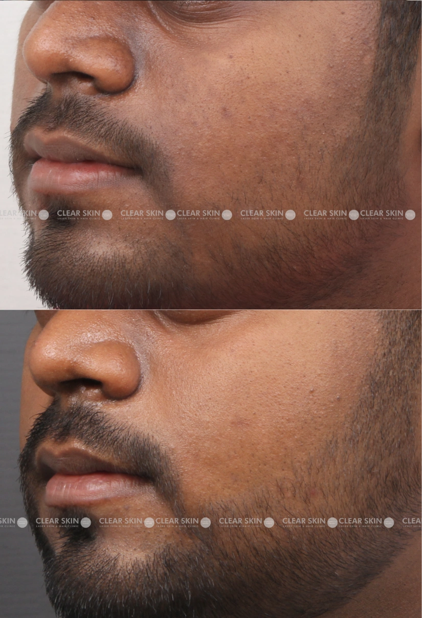 28yrs male Skin Rejuvenation Results 5 Months Timeline 4 Sessions ClearSkin Pune 