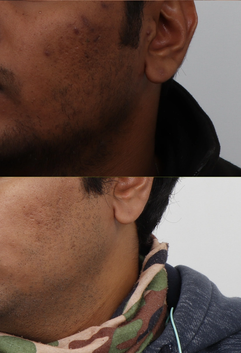 29 Pigmentation Results 3 Months Timeline 4 Sessions ClearSkin Pune