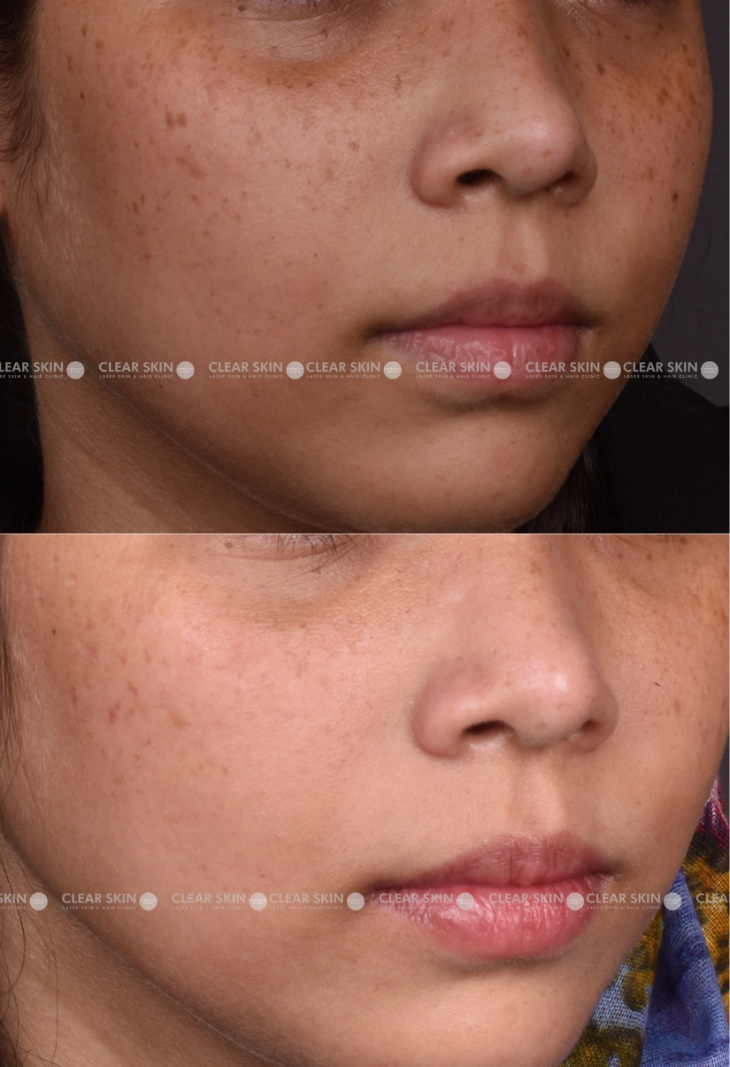 29yrs Female Freckles Results 5 Months Timeline 5 Sessions ClearSkin Pune