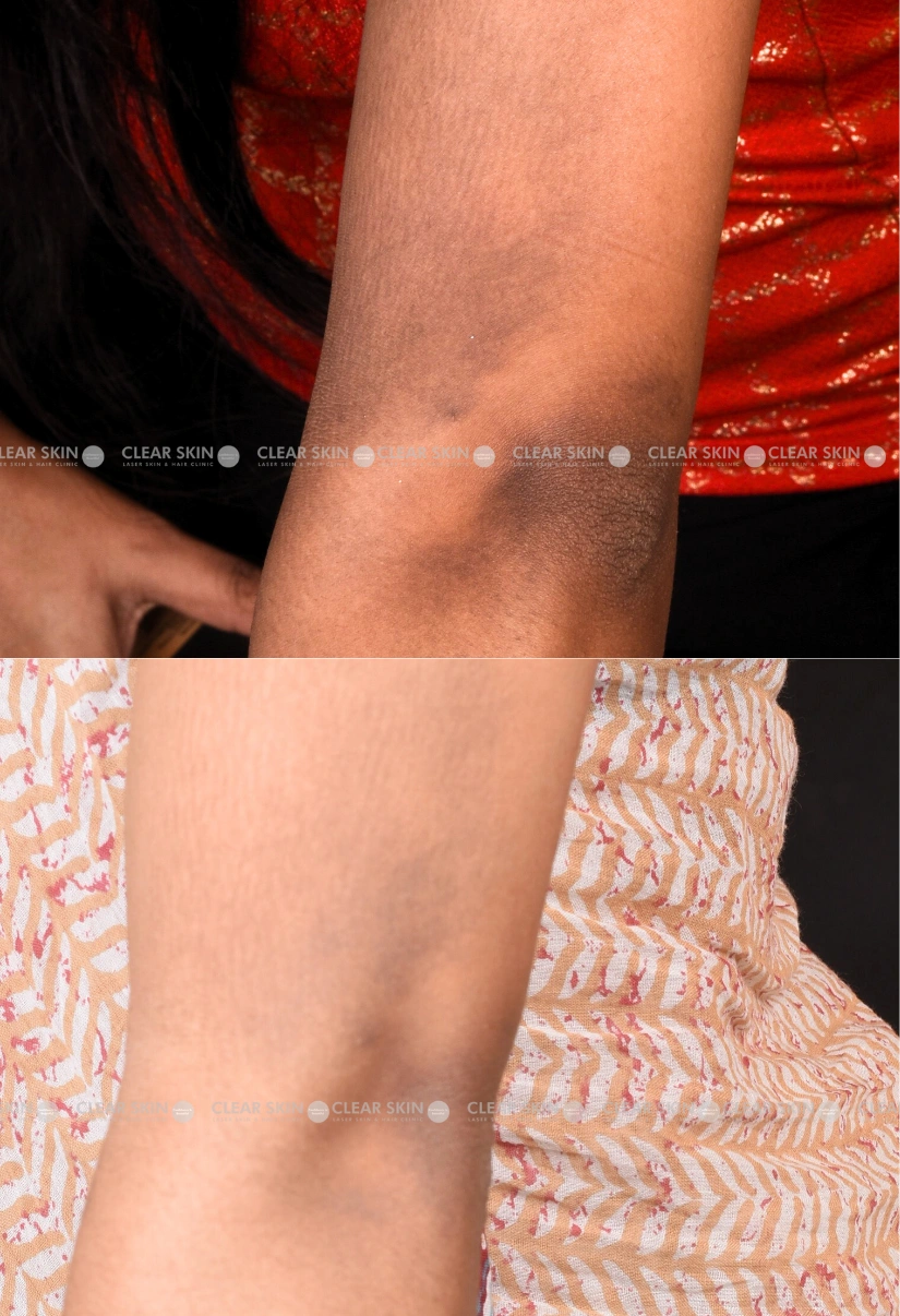 29yrs Female Pigmentation Results 1 Months Timeline 1 Sessions ClearSkin Pune