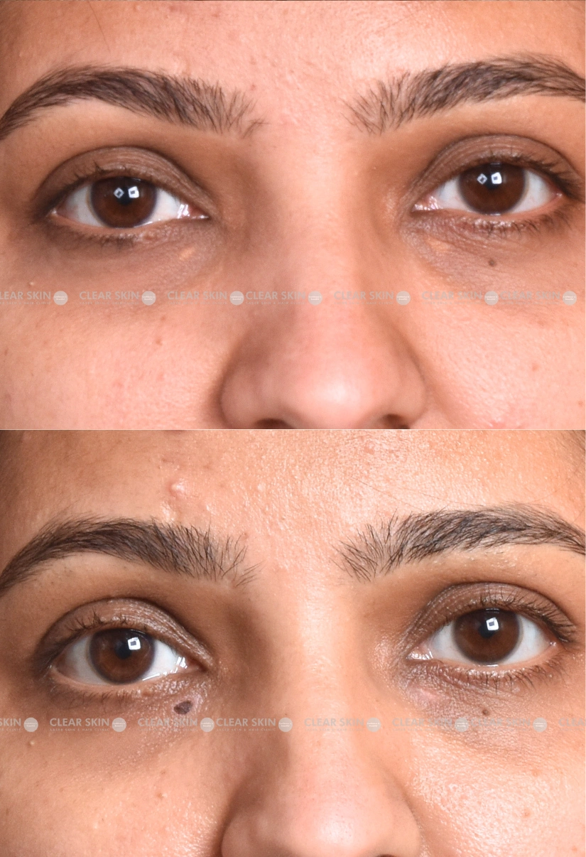 29yrs Female Xanthalasma Results 1 Months Timeline 1 Sessions ClearSkin Pune