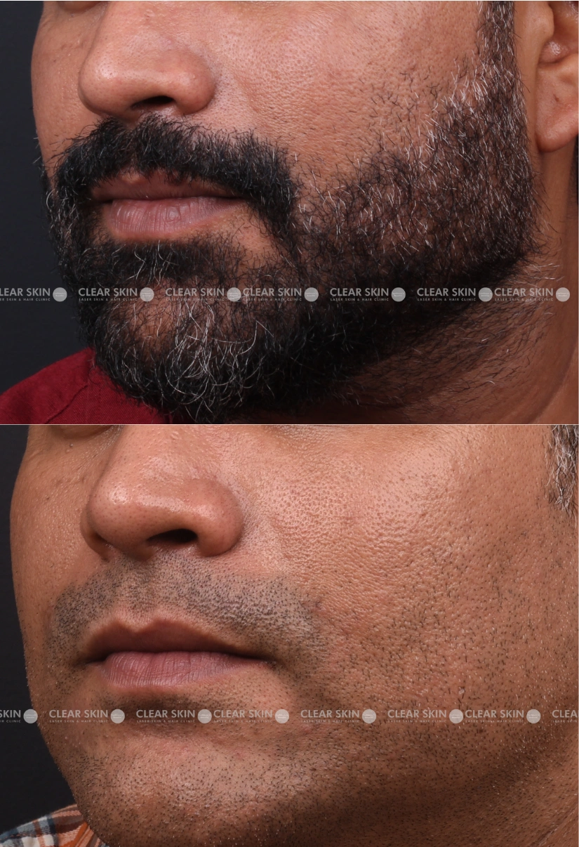 29yrs male Skin Rejuvenation Results 1 Months Timeline 2 Sessions ClearSkin Pune 