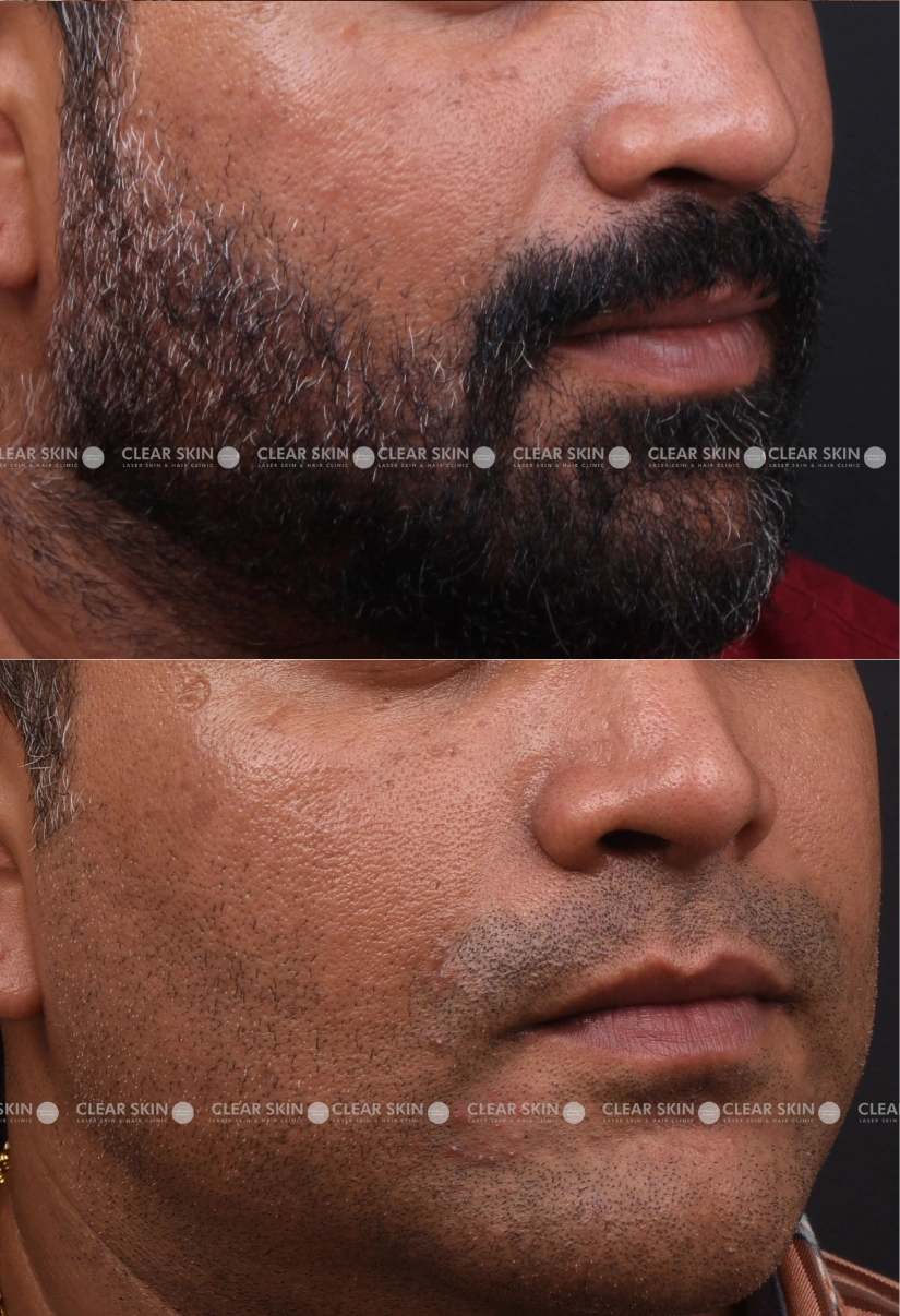 29yrs old Male Skin Rejuvenation Results 1 Months Timeline 2 Sessions ClearSkin Pune 