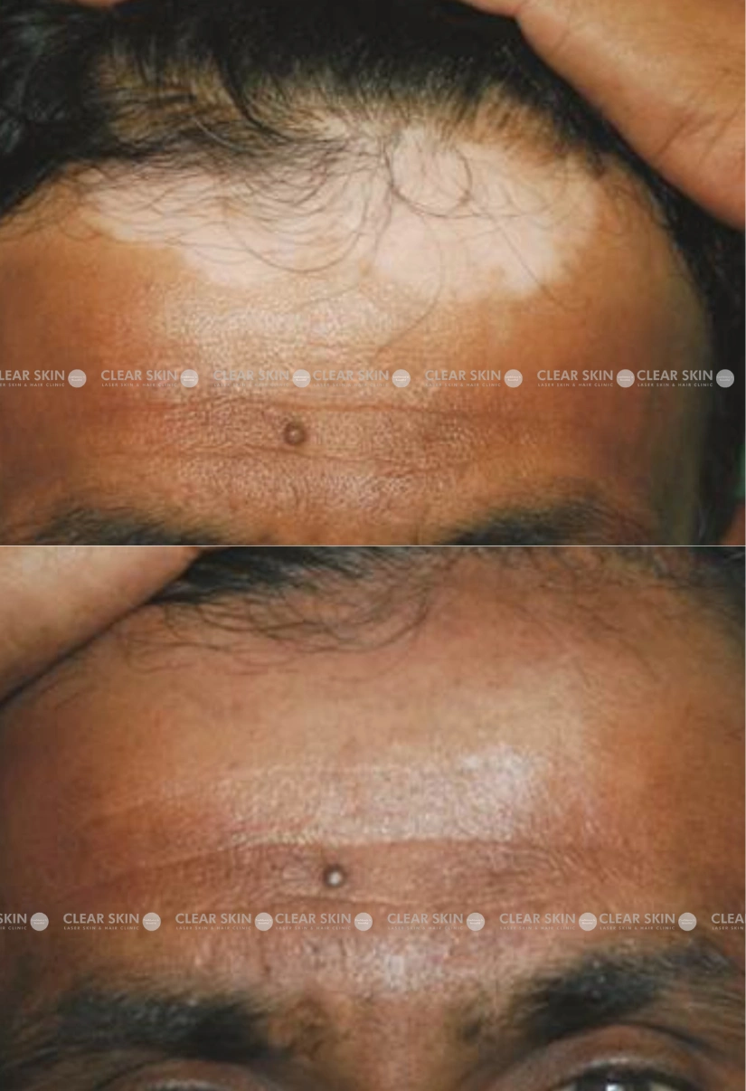 30Years male Vitiligo Results 2 Sessions 2 Months ClearSkin Pune 