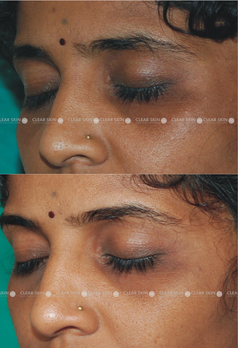 30yrs Female Darkcircles Results 4 Months Timeline 5 Sessions ClearSkin Pune (2)