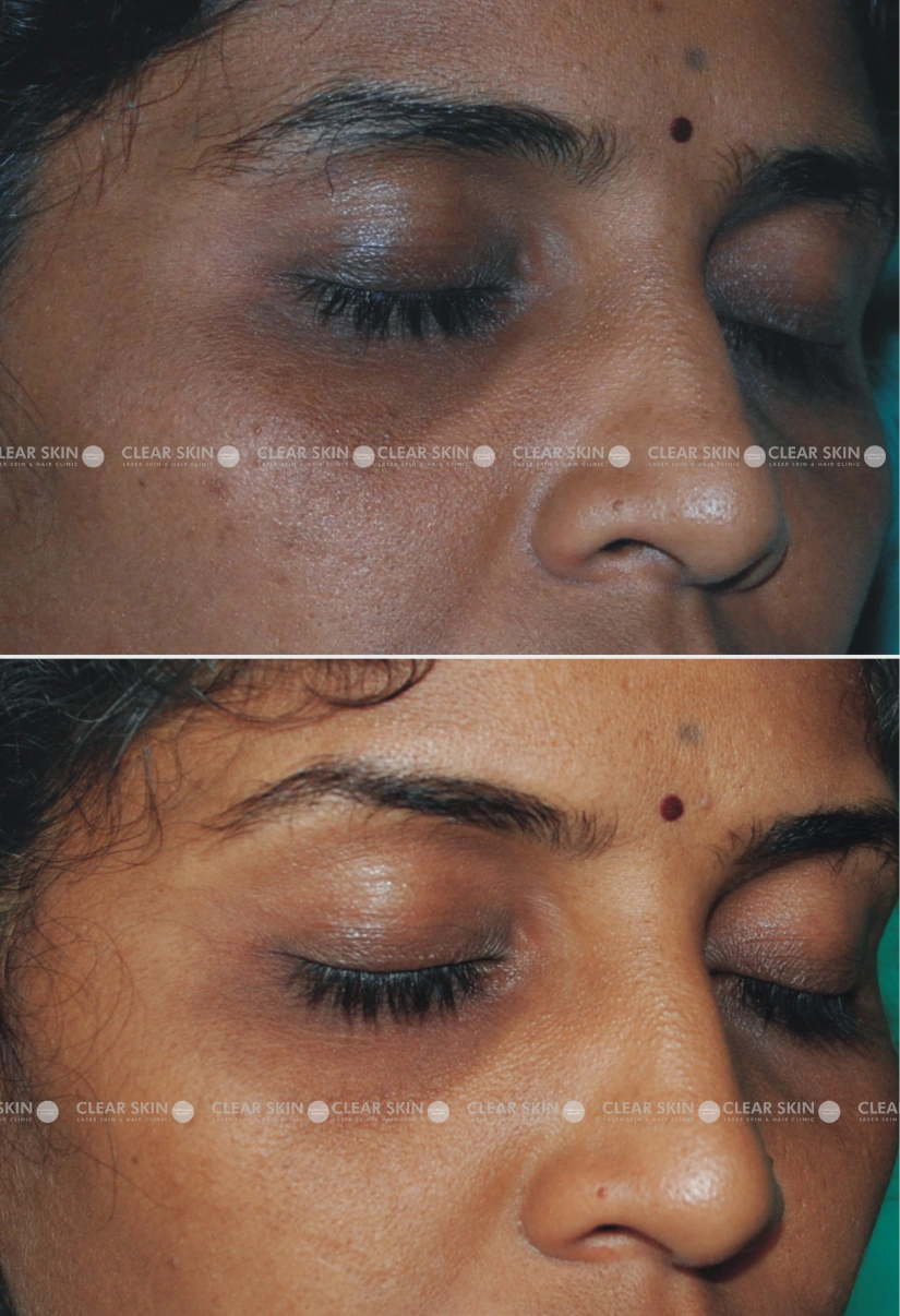 30yrs Female Darkcircles Results 4 Months Timeline 5 Sessions ClearSkin Pune (3)