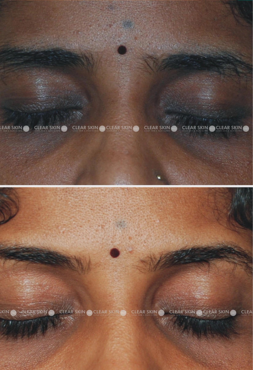 30yrs Female Darkcircles Results 4 Months Timeline 5 Sessions ClearSkin Pune