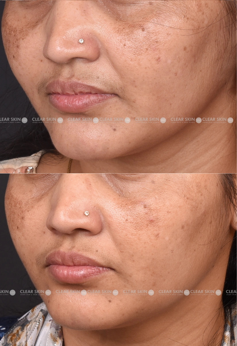 30yrs Female Freckles Results 3 Months Timeline 3 Sessions ClearSkin Pune 