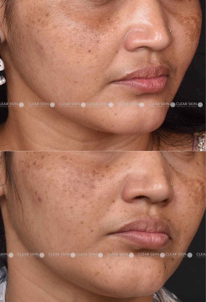 30yrs Female Freckles Results 3 Months Timeline 3 Sessions ClearSkin Pune 