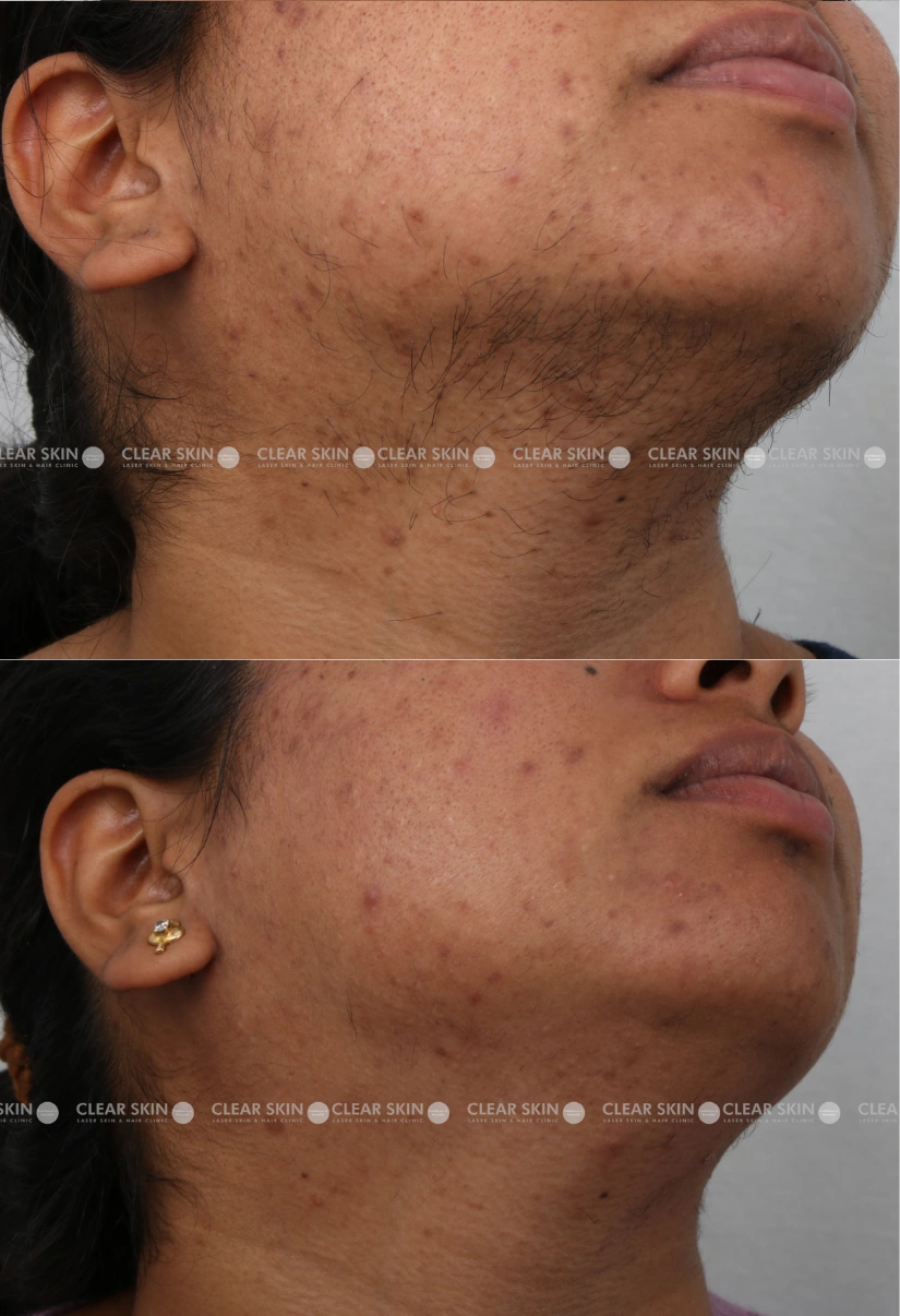 30yrs Female LHR Results 9 Months Timeline 9 Sessions ClearSkin Pune-3 (2)