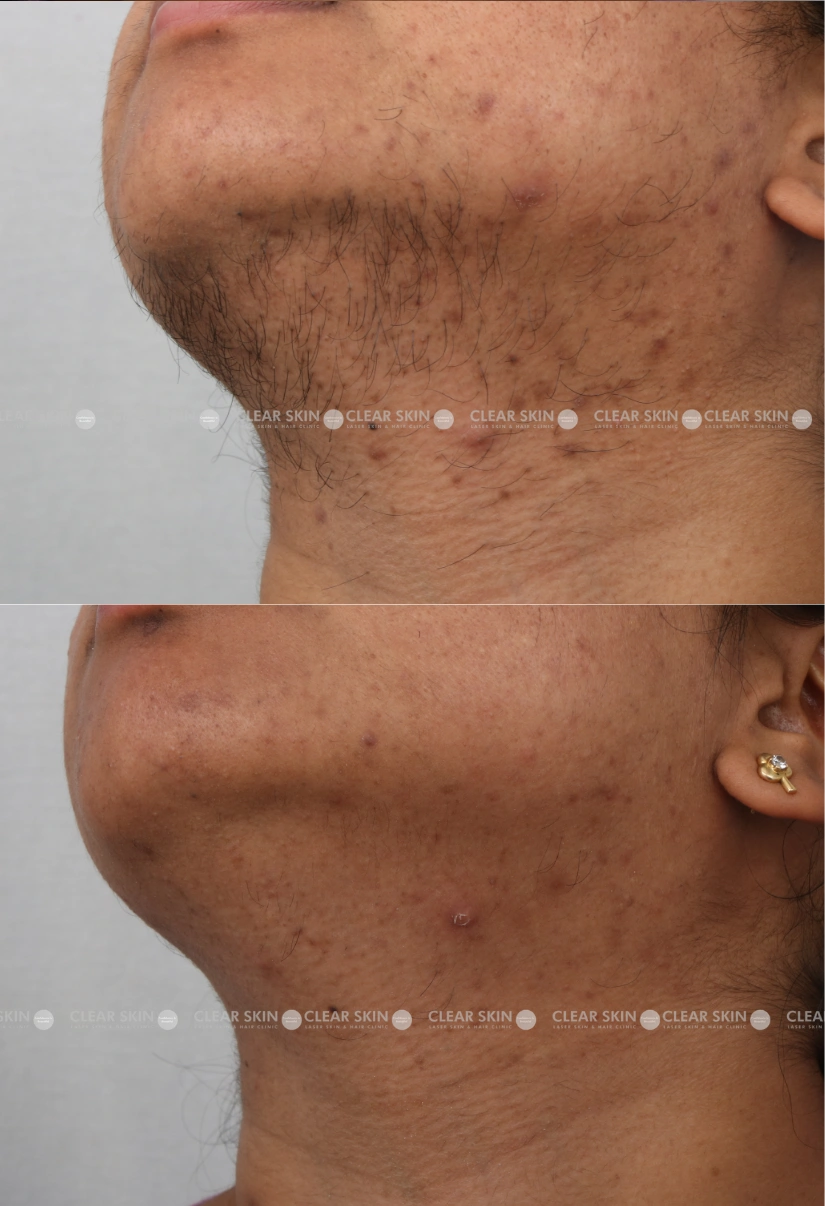 30yrs Female LHR Results 9 Months Timeline 9 Sessions ClearSkin Pune-3 (3)